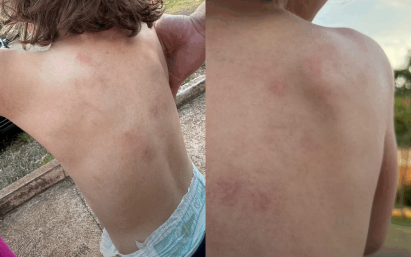 Hematomas em criança autista assistida pela APAE Ituiutaba.