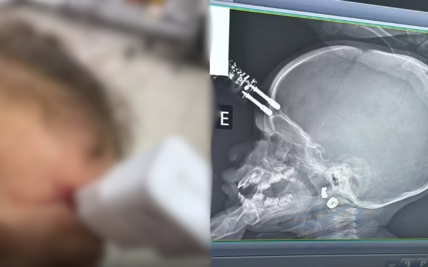 Bebê de um ano após acidente doméstico com carregador de celular