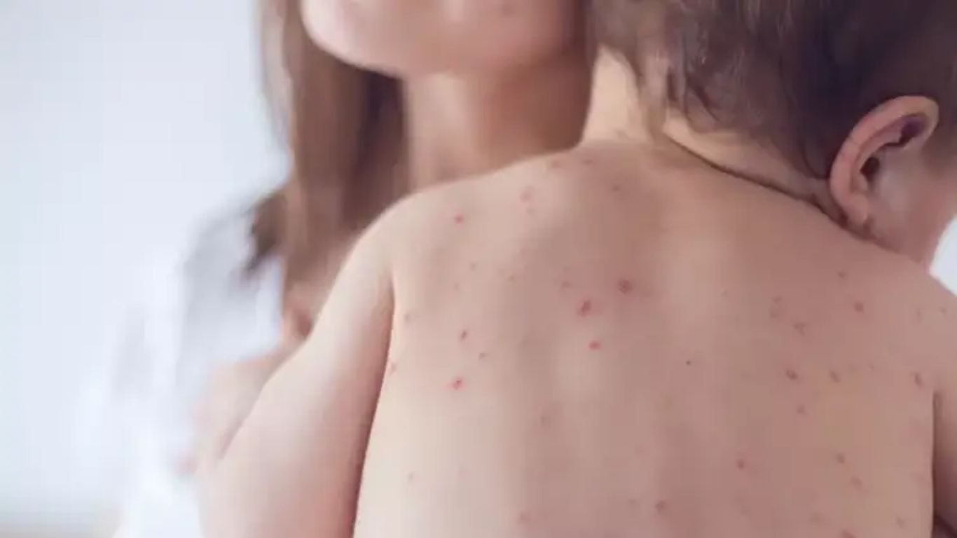 Criança com sintomas de sarampo.